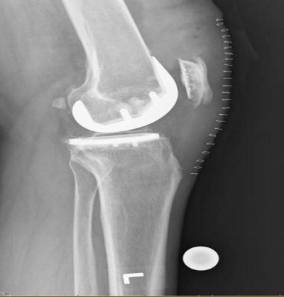 Knee Prostheses:  Bicompartmental:  Smith & Nephew Deuce (Implant 805)